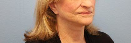 Mini Facelift Before & After Patient #8208
