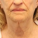 Mini Facelift Before & After Patient #8208