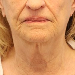 Mini Facelift Before & After Patient #8208