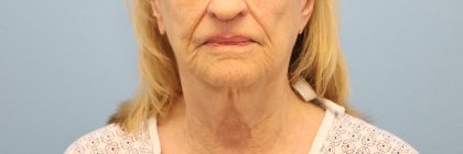 Mini Facelift Before & After Patient #8208