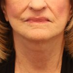 Mini Facelift Before & After Patient #8208