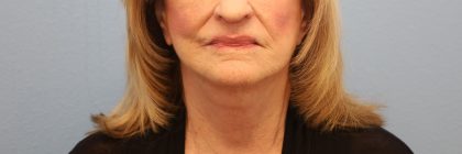 Mini Facelift Before & After Patient #8208
